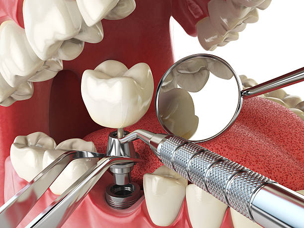 Best Chipped Tooth Repair Near Me  in Ensley, FL
