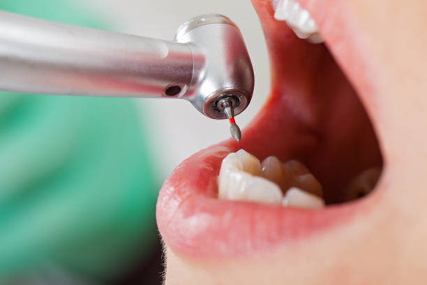 Best Knocked-Out Tooth Emergency  in Ensley, FL